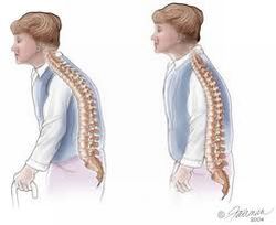osteoporoza